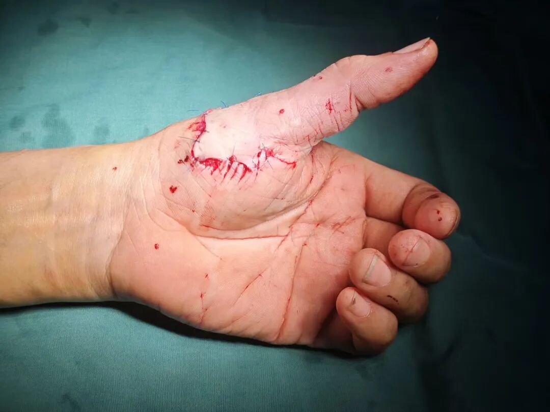 接连多起!骨科断指再植