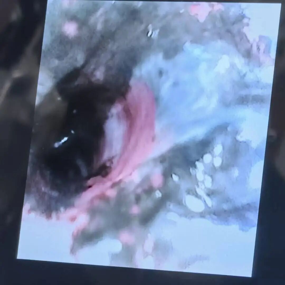 重度气道烧伤!多科协作闯难关