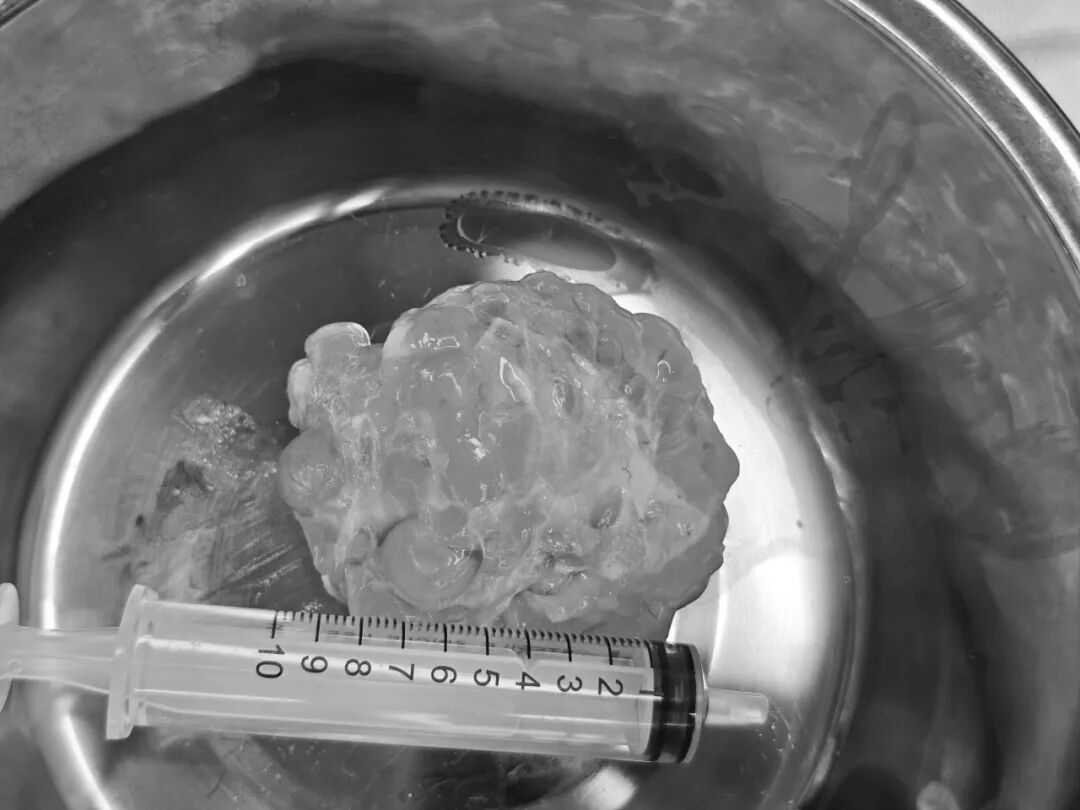 大肿块?小痕迹!新方案这样做