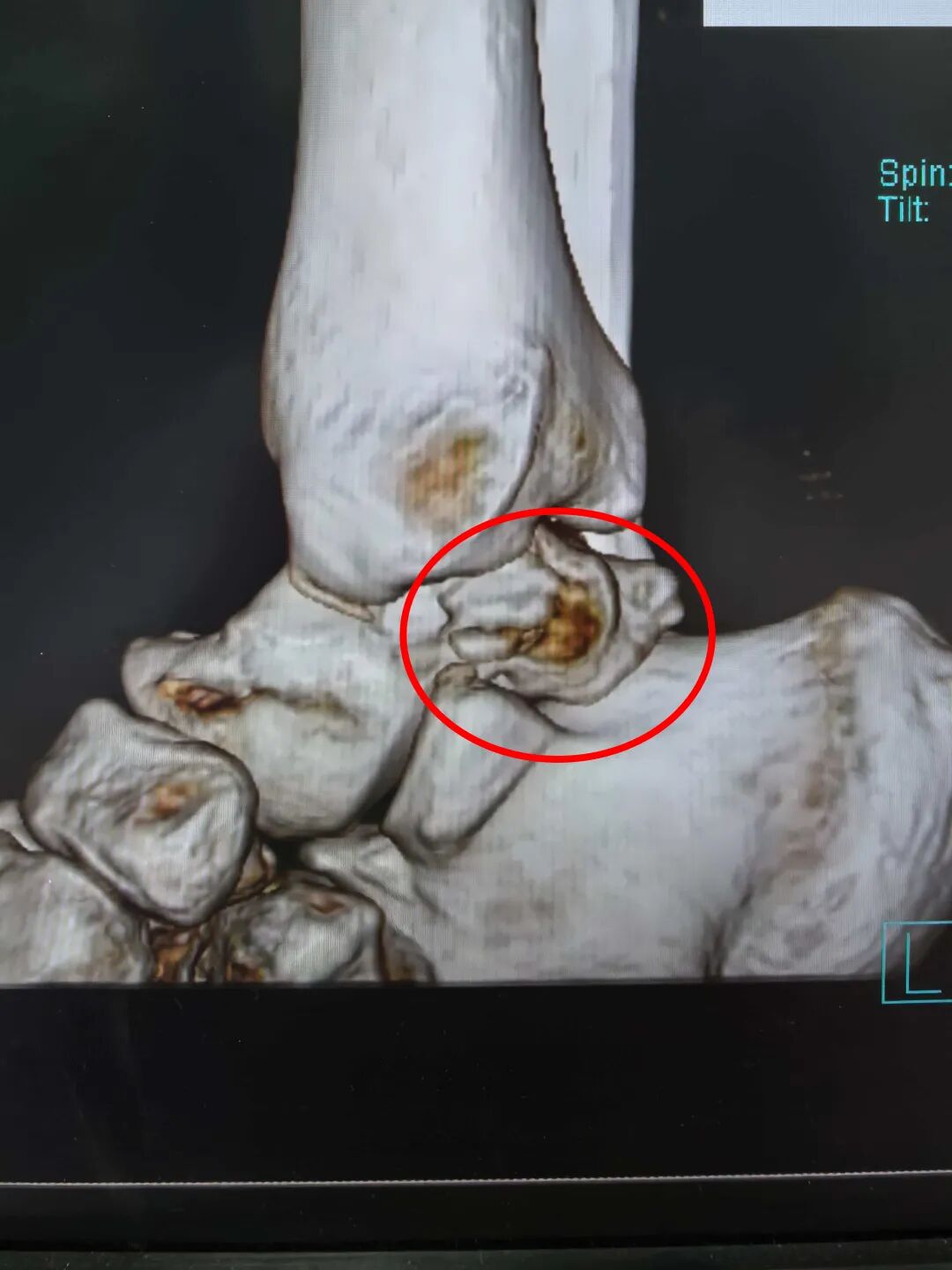 可吸收内固定 让骨折告别二次手术