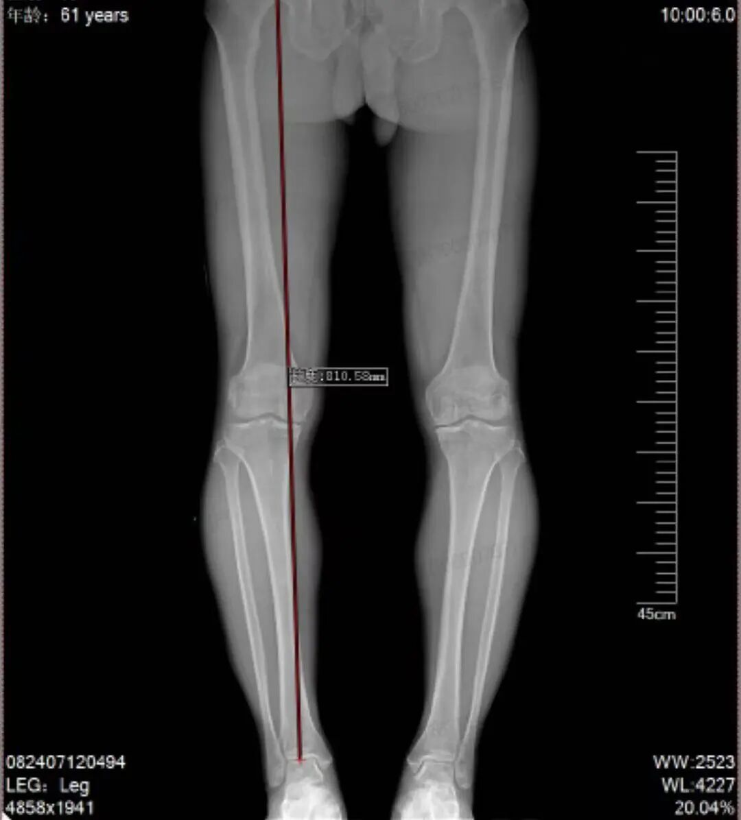 「O 型腿」折磨一年 成功「保膝」