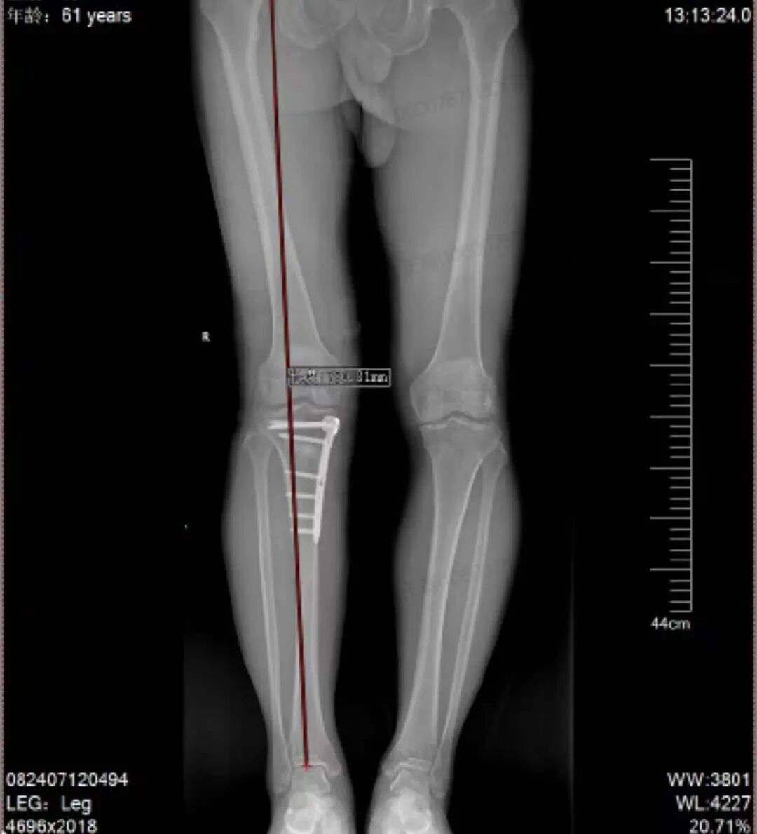「O 型腿」折磨一年 成功「保膝」