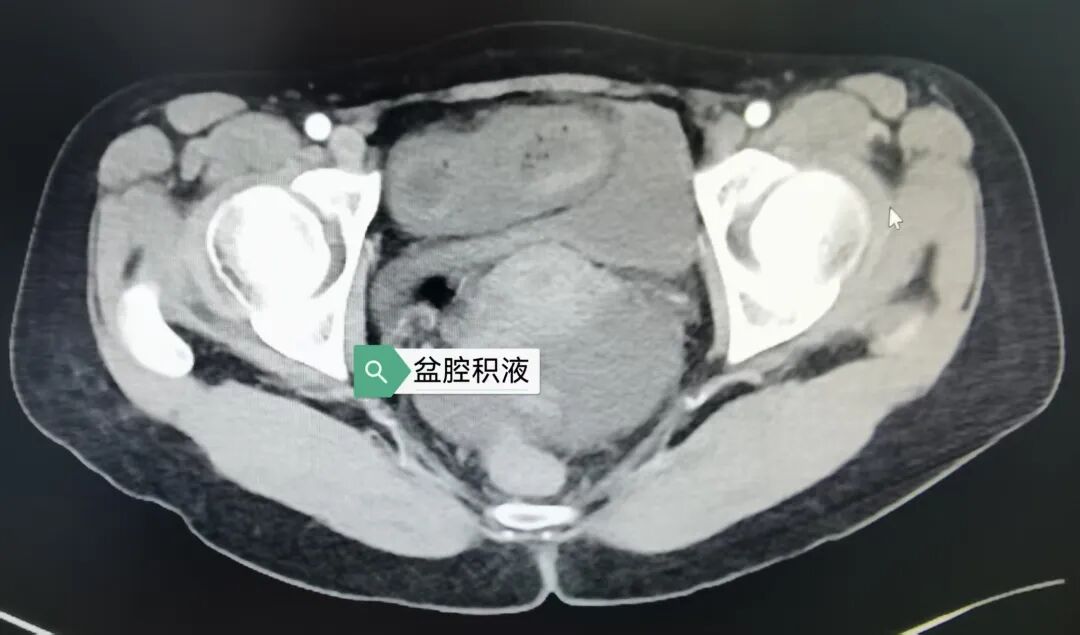 40 cm 小肠坏死！年轻妈妈的惊险一夜