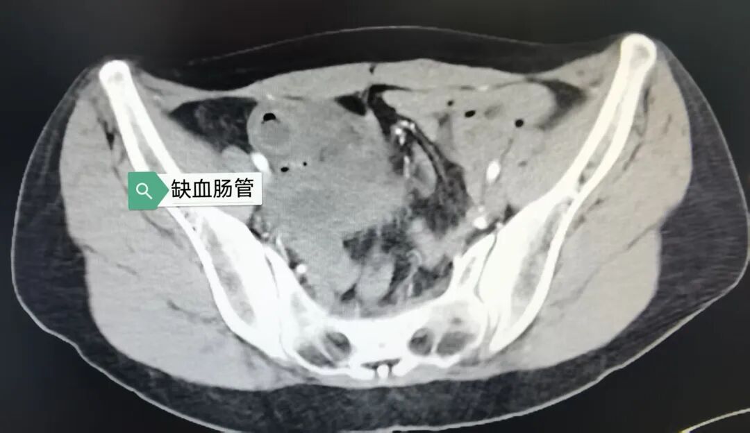 40 cm 小肠坏死！年轻妈妈的惊险一夜