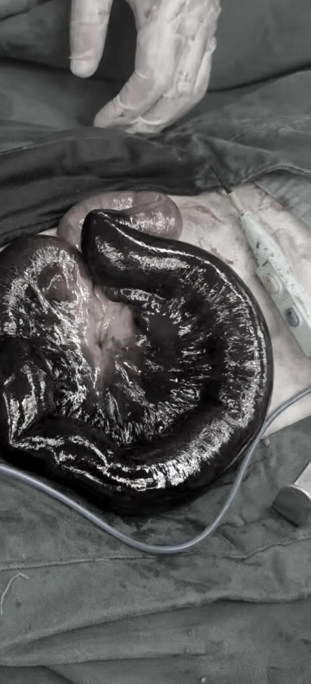 40 cm 小肠坏死！年轻妈妈的惊险一夜