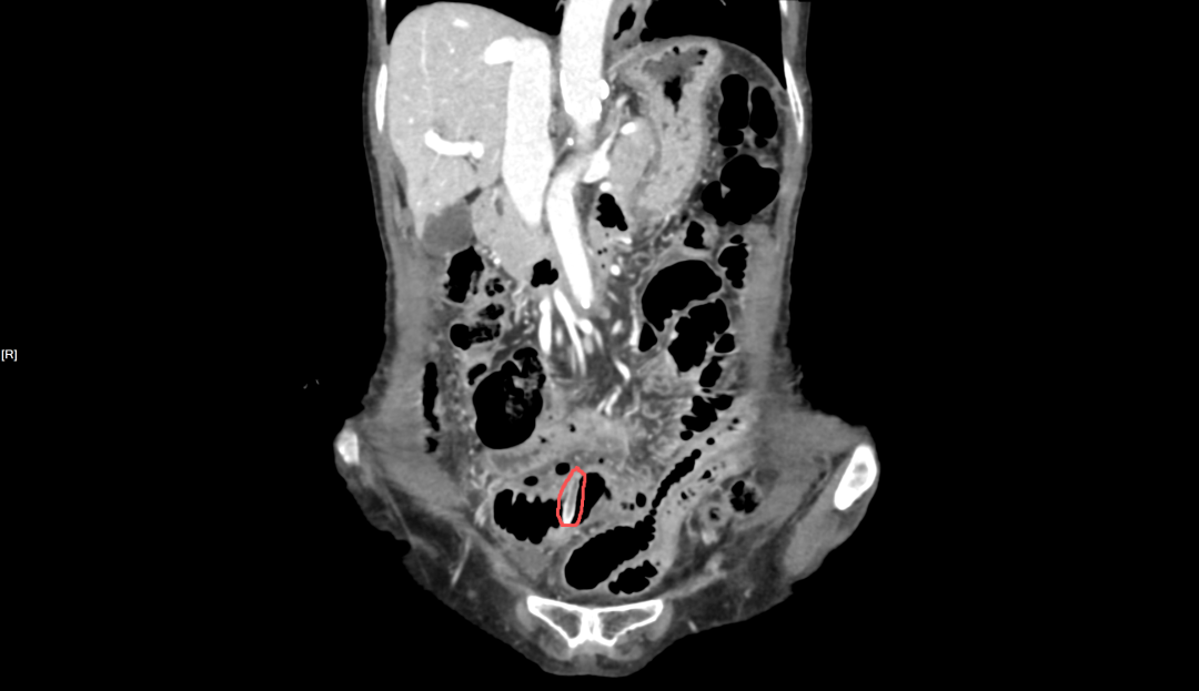 险些刺穿大动脉!这种「养生果」要当心