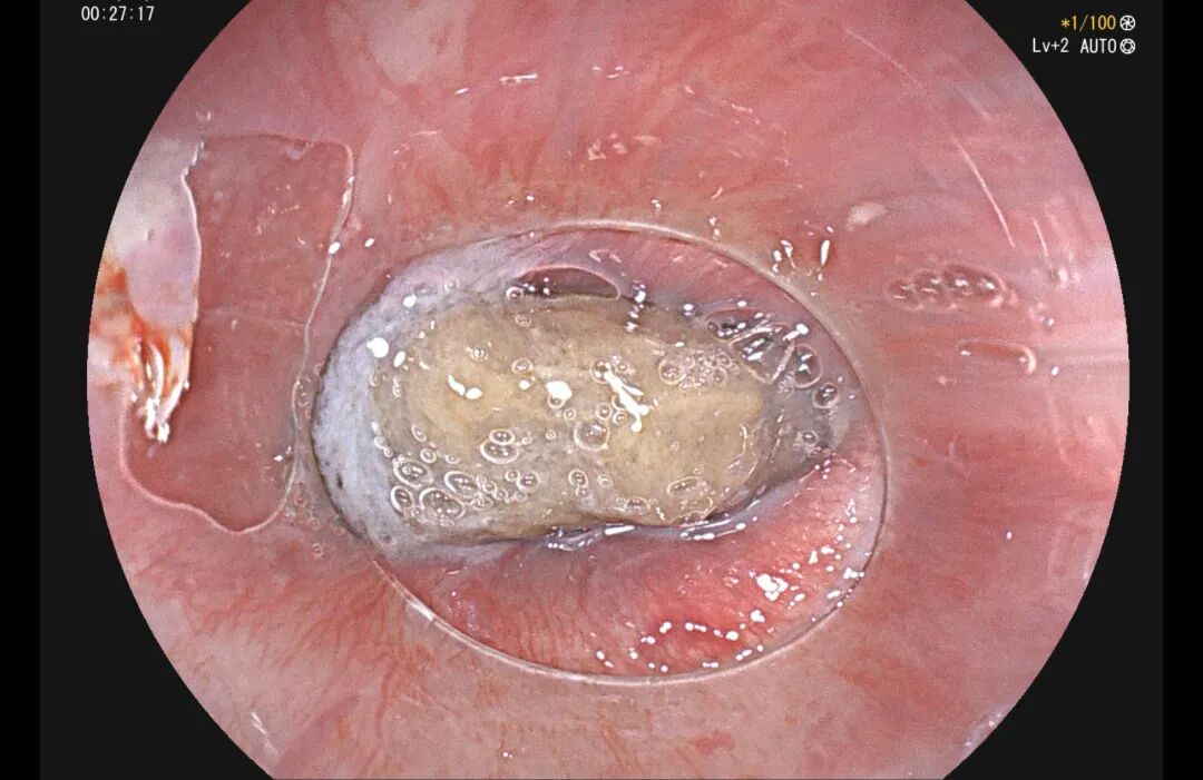险些刺穿大动脉!这种「养生果」要当心