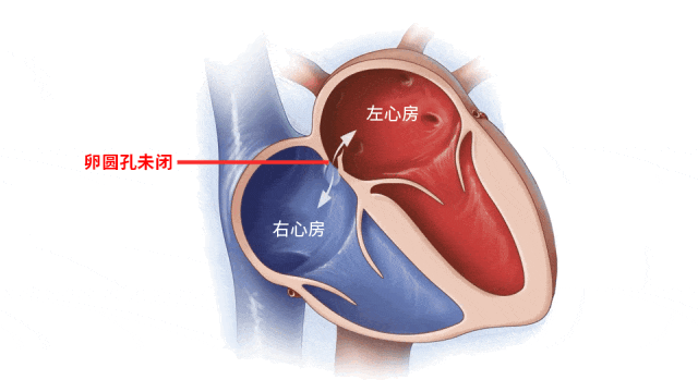 突然倒地！竟是心脏上有个「洞」