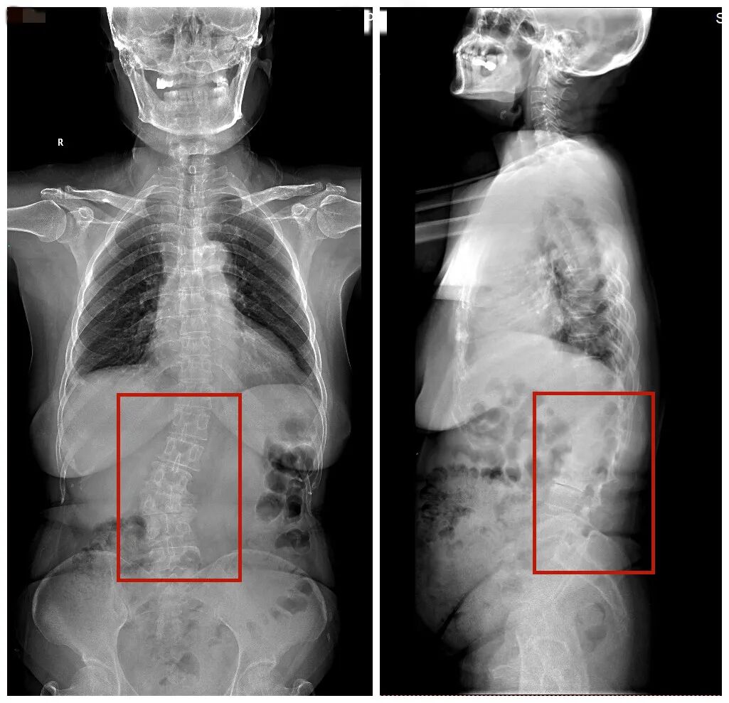 20 年腰痛 脊柱侧弯是元凶
