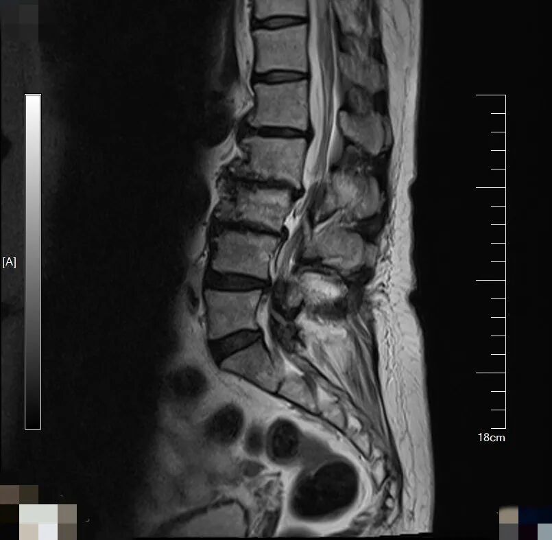 20 年腰痛 脊柱侧弯是元凶