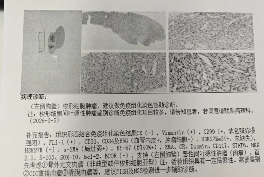 【高尚病例】骨外尤文氏肉瘤一例