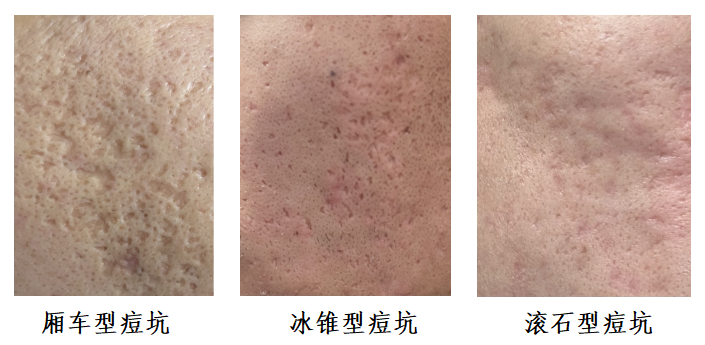 医路科普 | 痘坑治疗,为什么我的治疗效果不好?