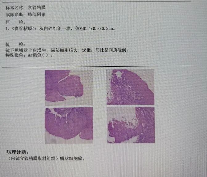【高尚病例】58 岁男吞咽困难，被查出食管鳞癌