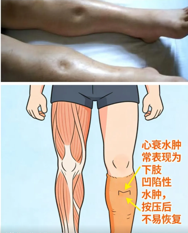同样是喝水,为啥心衰患者要 「限量」?