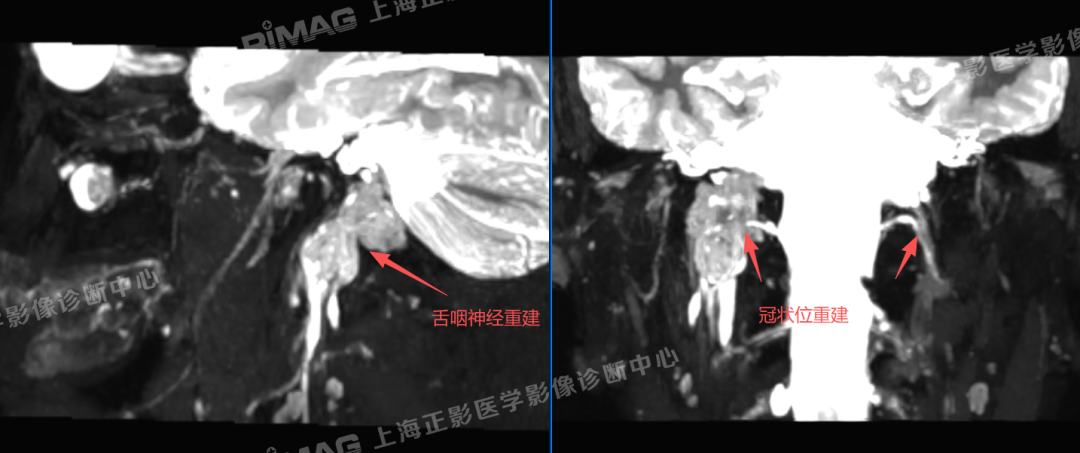 典型案例 | 一脉阳光三维重建揭开舌咽神经鞘瘤真相,全程协助快速衔接临床治疗