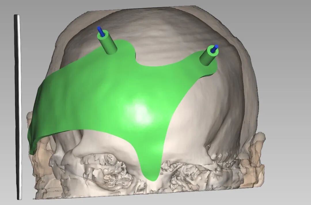 3D 打印精准导航 | 遂川共享中心运营部助力院脑外科成功完成丘脑出血微创辅助手术