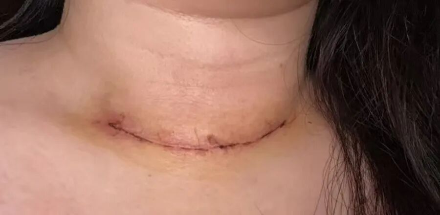 把切口藏进乳晕!我院完成增城区首例经乳晕腔镜下甲状腺全切+侧颈区淋巴结清扫术