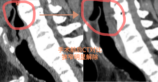 这种罕见颈椎病，竟让湖北男子千里求医