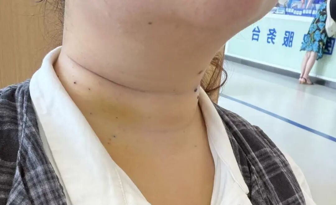 把切口藏进乳晕!我院完成增城区首例经乳晕腔镜下甲状腺全切+侧颈区淋巴结清扫术