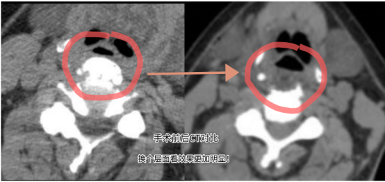 这种罕见颈椎病，竟让湖北男子千里求医