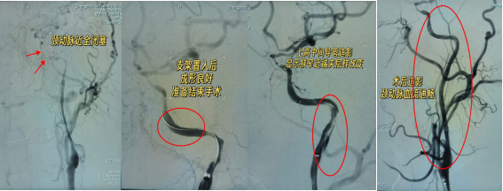 与时间赛跑,为大脑抢路丨 8 例典型取栓病例纪实
