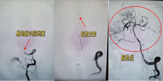 与时间赛跑,为大脑抢路丨 8 例典型取栓病例纪实