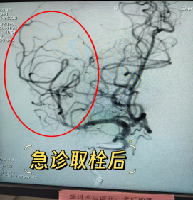 与时间赛跑,为大脑抢路丨 8 例典型取栓病例纪实