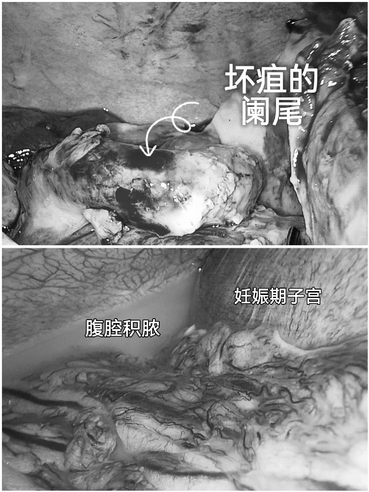 有惊无险！当孕 20 周遇上急性阑尾炎……