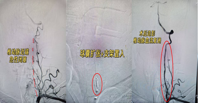 与时间赛跑,为大脑抢路丨 8 例典型取栓病例纪实