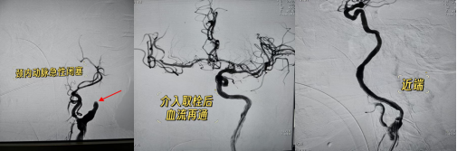 与时间赛跑,为大脑抢路丨 8 例典型取栓病例纪实