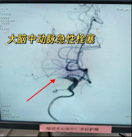与时间赛跑,为大脑抢路丨 8 例典型取栓病例纪实