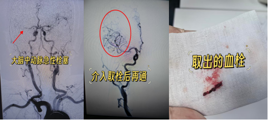 与时间赛跑,为大脑抢路丨 8 例典型取栓病例纪实