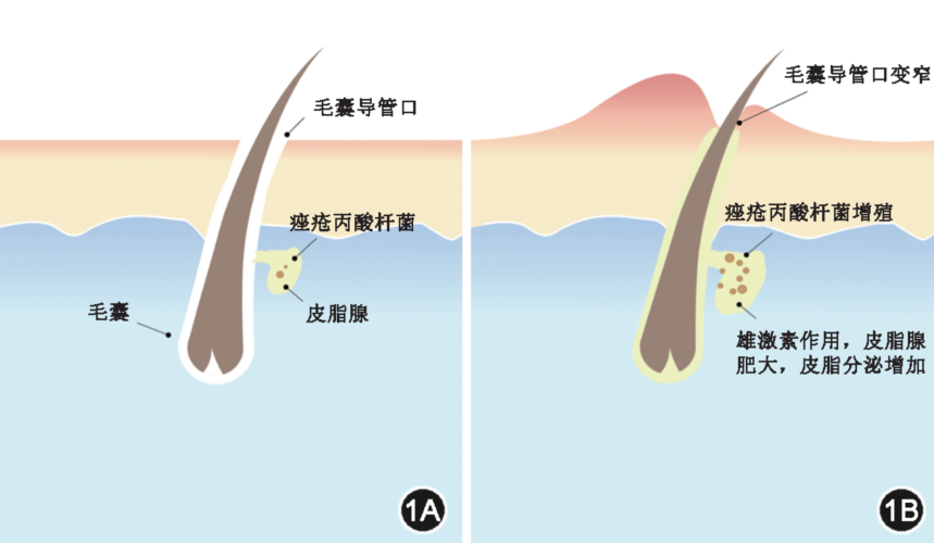 长痤疮了啷个办? 科学战「痘」,莫踩这些坑!