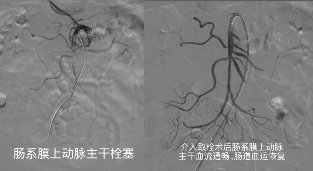 生死竞速抢生机!两院联动成功救治高致死率「肠道卒中」患者