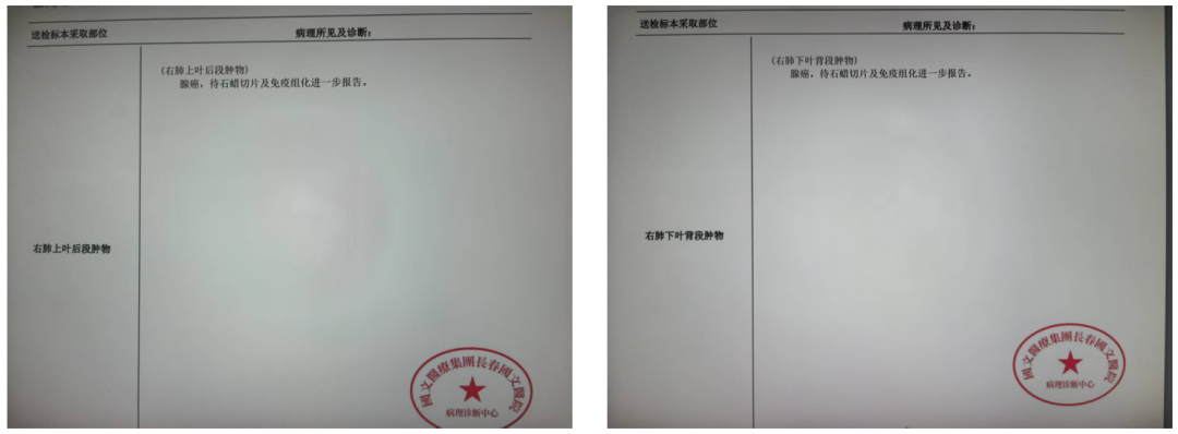 肺结节年轻化不用慌!精准切除病灶,国文医院胸外科守护肺部健康