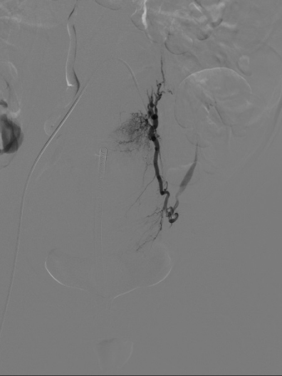 产后突发出血 1000 毫升,多学科专家团队深夜 2 小时「生命接力」