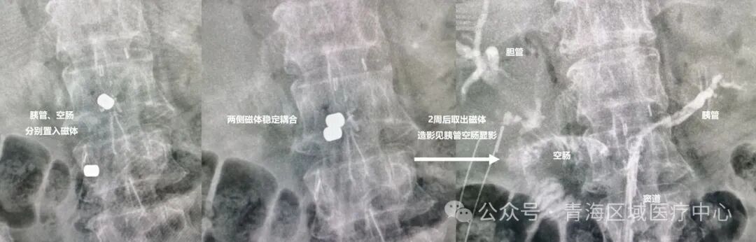 填补省内技术空白|青海首例磁压榨胰肠吻合术在交大一附院青海医院落地