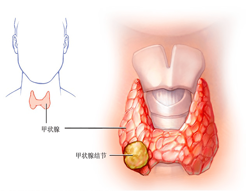 查出甲状腺结节=得了癌症?真相在这里!