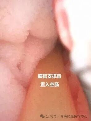 填补省内技术空白|青海首例磁压榨胰肠吻合术在交大一附院青海医院落地