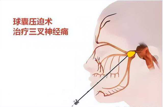 三叉神经痛不用硬扛!一根细针,半小时微创手术解除数年剧痛!