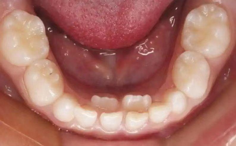 警惕!孩子换牙期 5 大误区,90% 家长都踩过