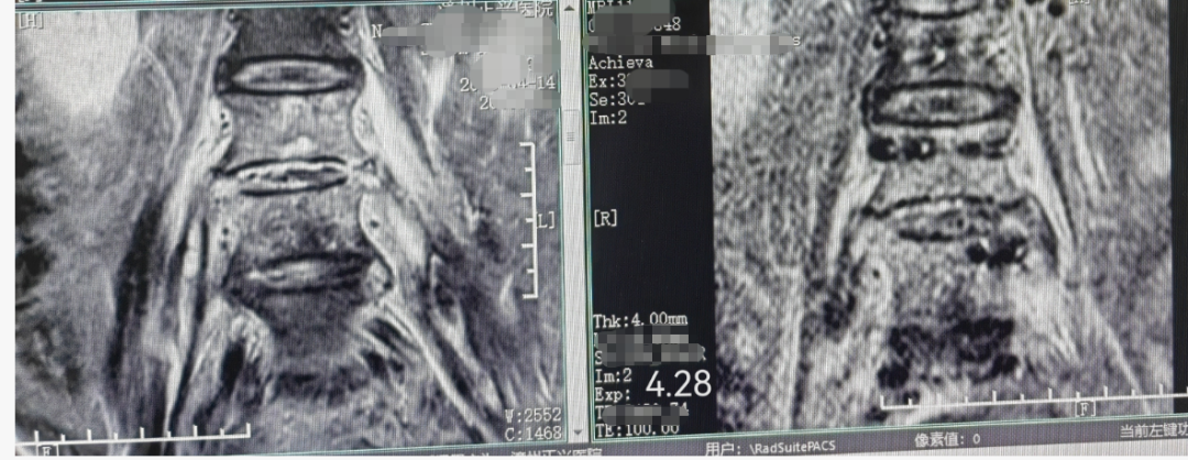 一场腰痛险致瘫!诏安阿伯体内惊现「噬骨」细菌