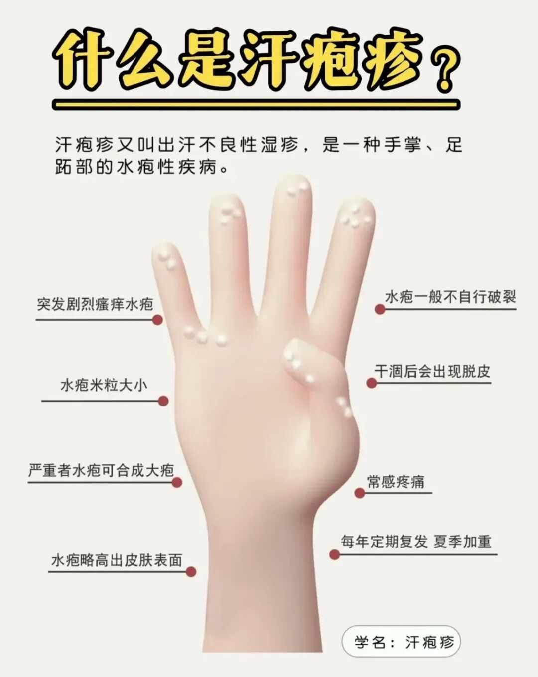 特别关注 | 夏天来了,如果你被汗疱疹盯上了......