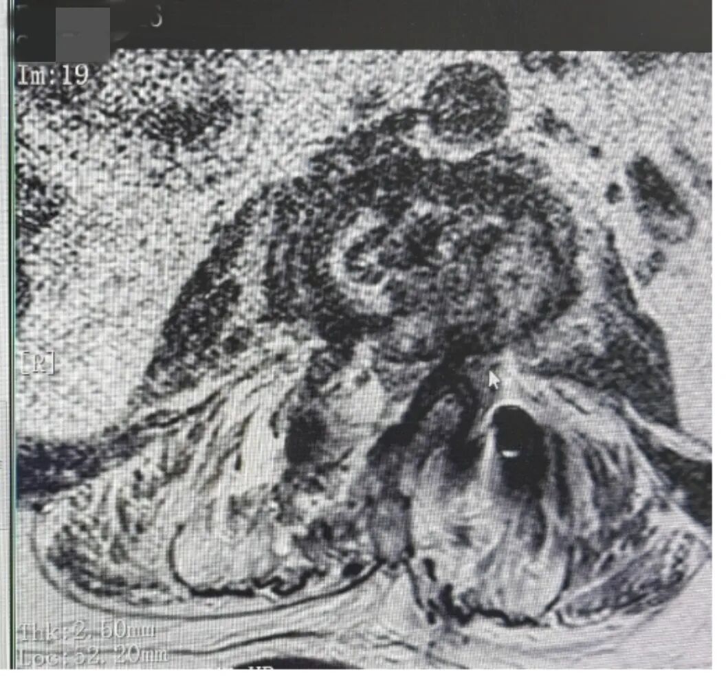 一场腰痛险致瘫!诏安阿伯体内惊现「噬骨」细菌