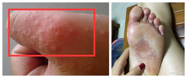 特别关注 | 夏天来了,如果你被汗疱疹盯上了......