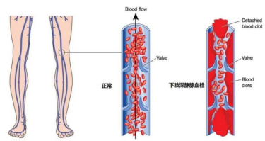 脑卒中后下肢静脉血栓的预防