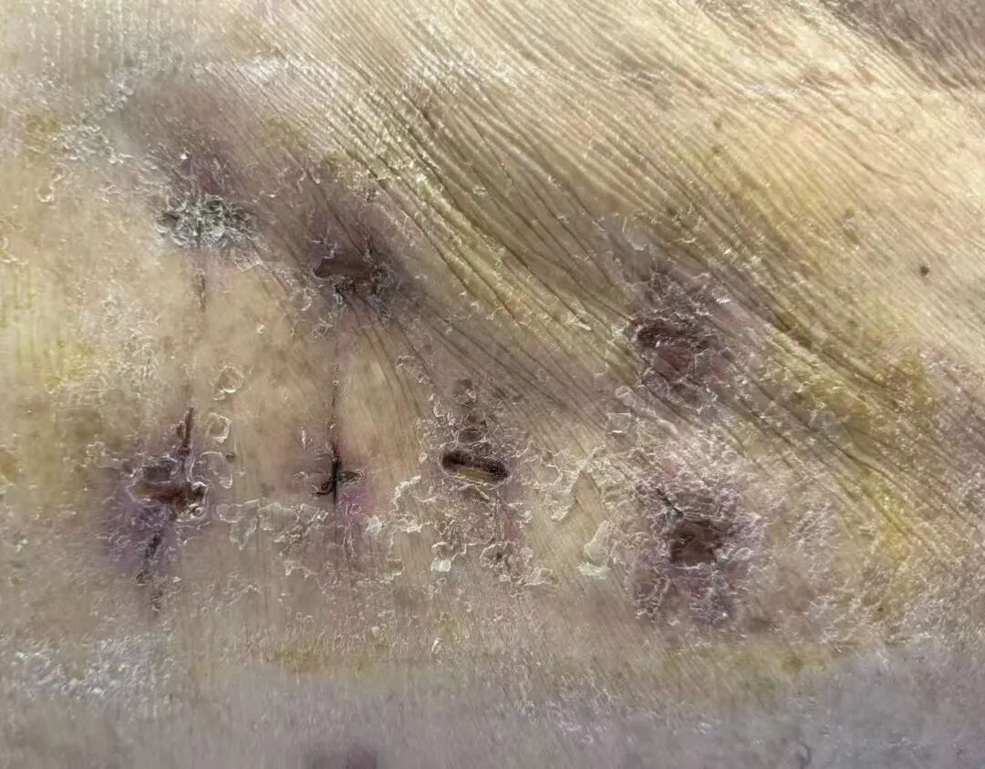 一场腰痛险致瘫!诏安阿伯体内惊现「噬骨」细菌