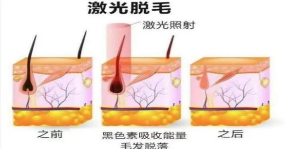 为什么我会「长胡子」?认识女性多毛症