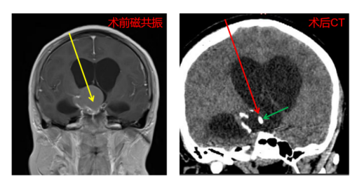 微创新高度!机器人辅助精准手术,让复杂脑病治疗更「聪明」