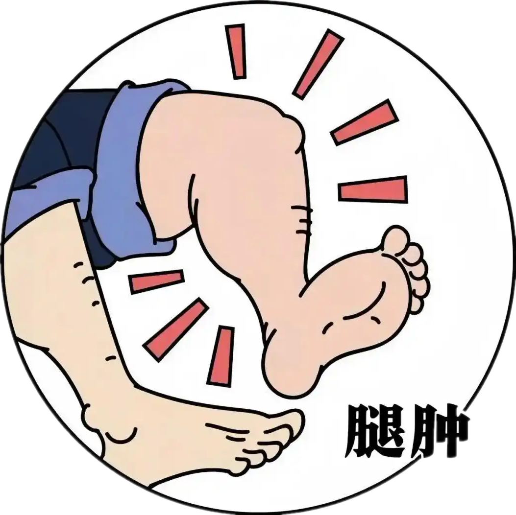 孕妈小腿突然肿至两倍粗!孕期水肿竟藏致命险疾